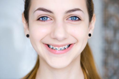 Braces, Straighter Smile, Traditional Braces