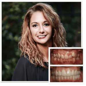Surgical Before and after Shannon